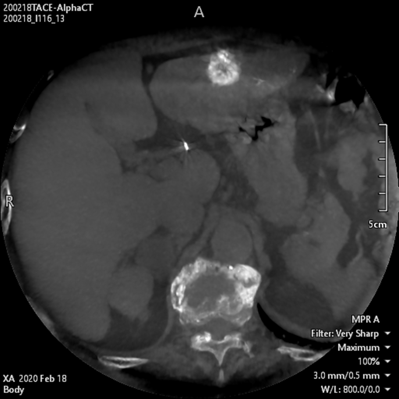 Abdominal Alpha CT