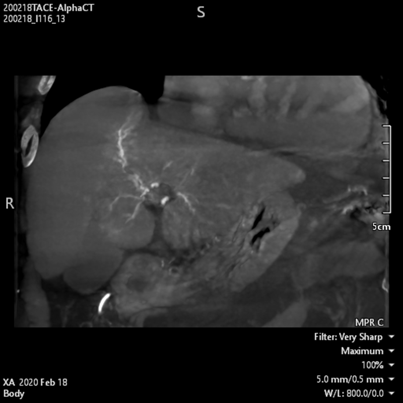 Abdominal Alpha CT