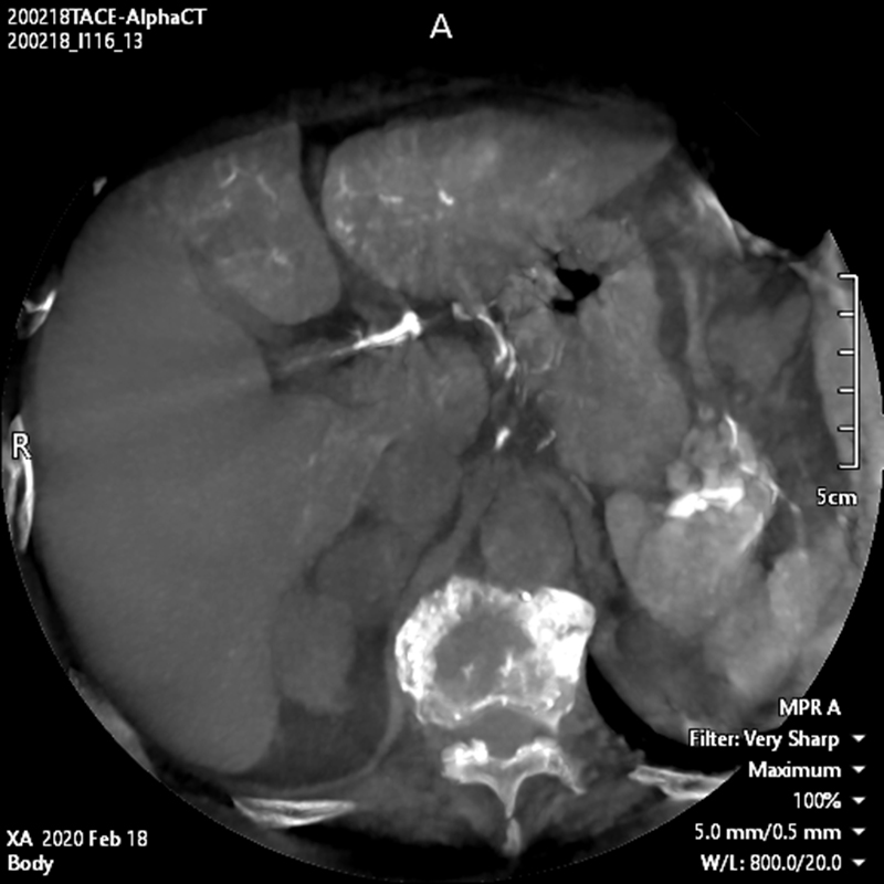Abdominal Alpha CT