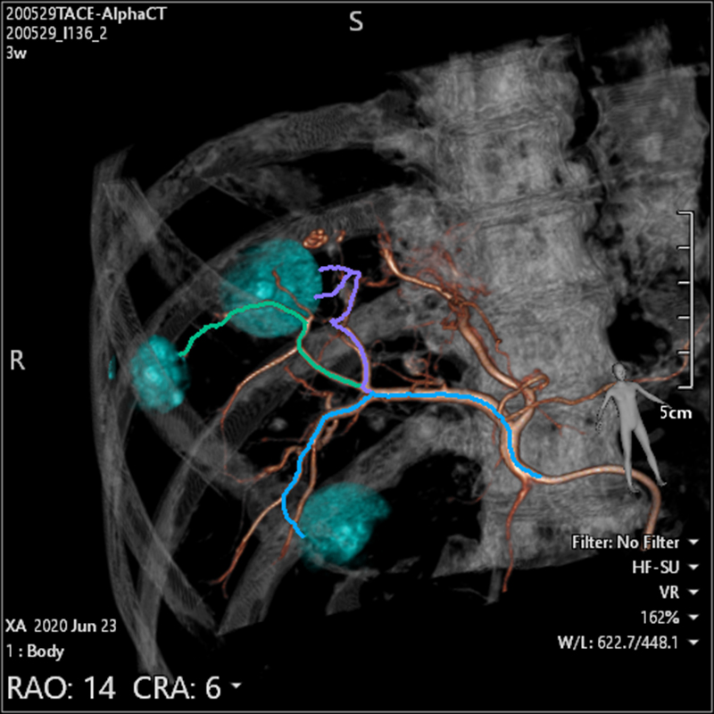 Embolization Plan