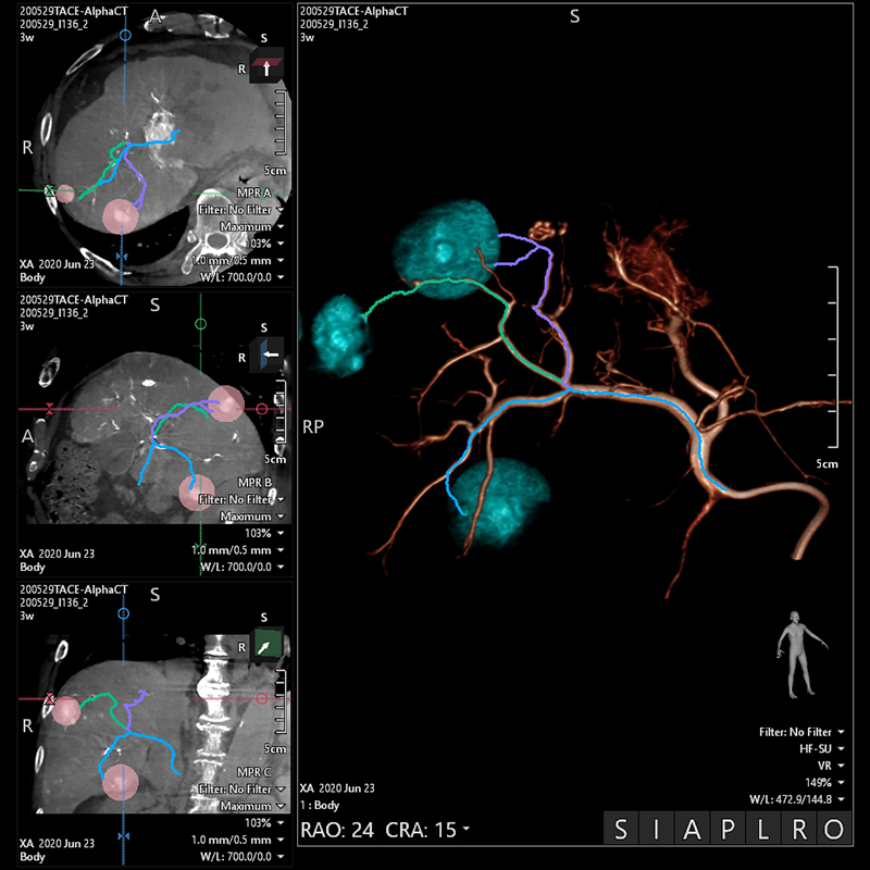 Embolization Plan