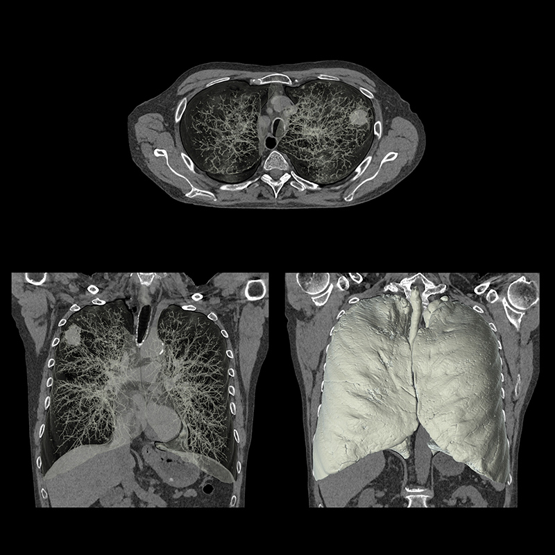 Masa pulmonar, HR, AiCE