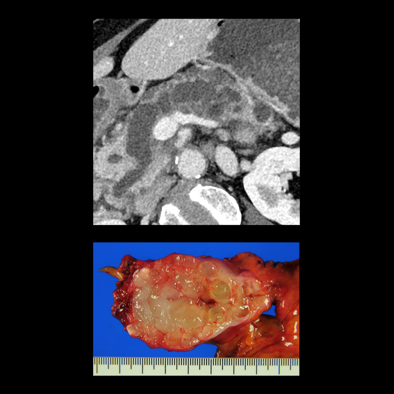 Cáncer pancreático de tipo mixto, SHR, AiCE
