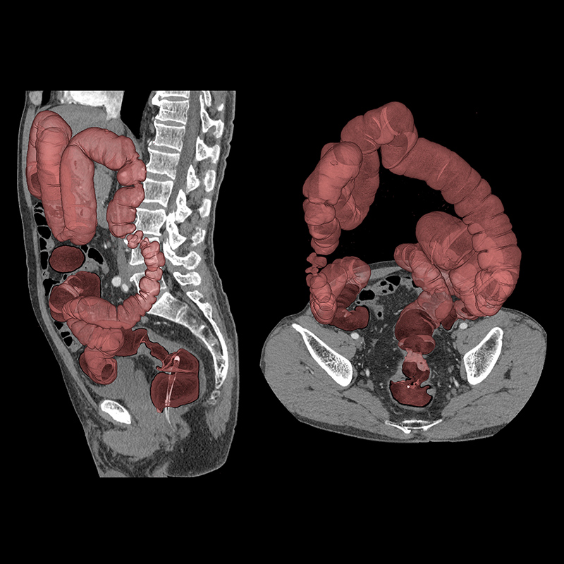 Cáncer Colo-Rectal, HR, AiCE