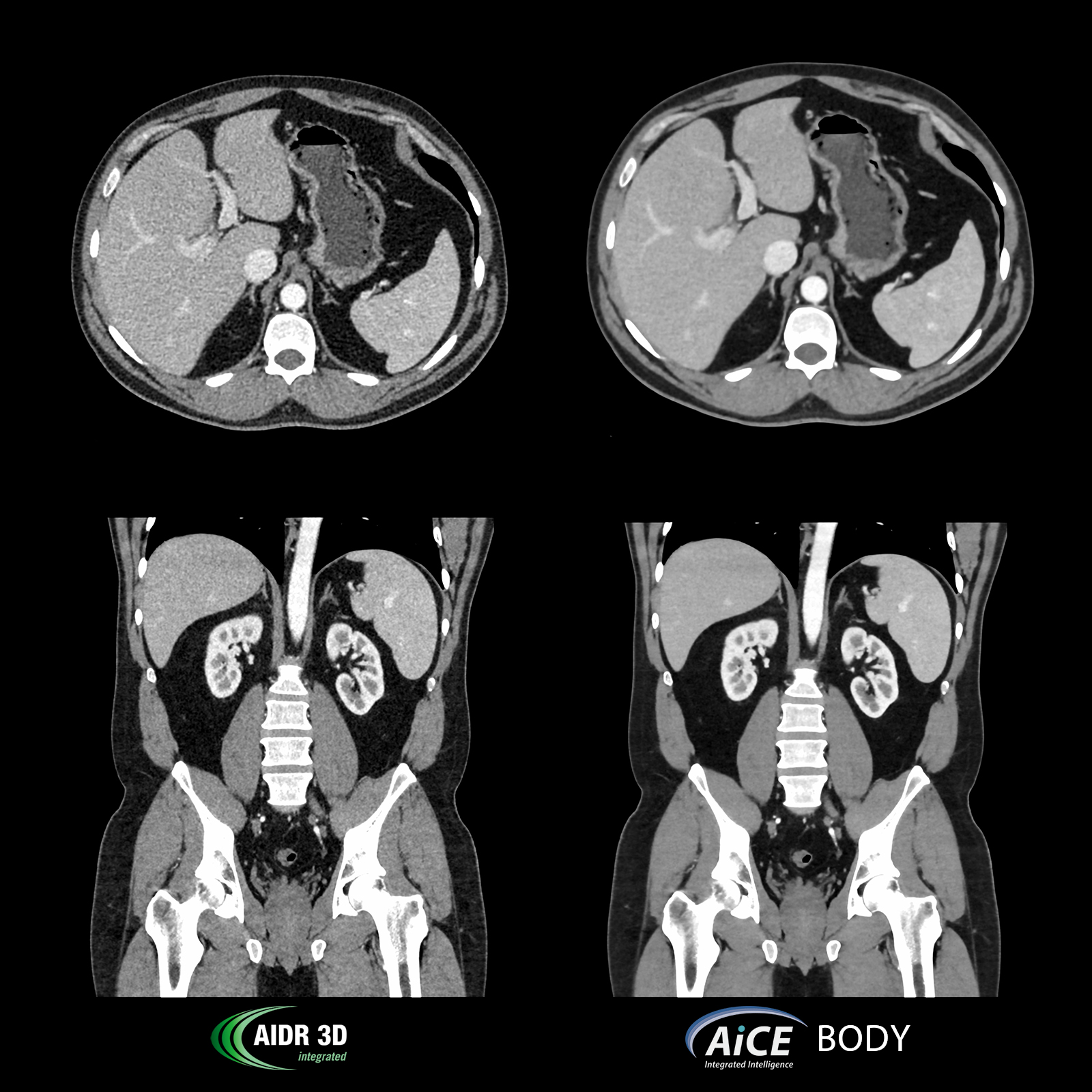 Abdomen Pelvis, AiCE