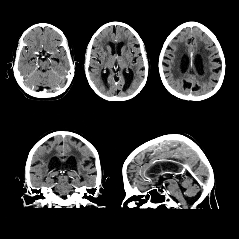 Cerebro, AiCE