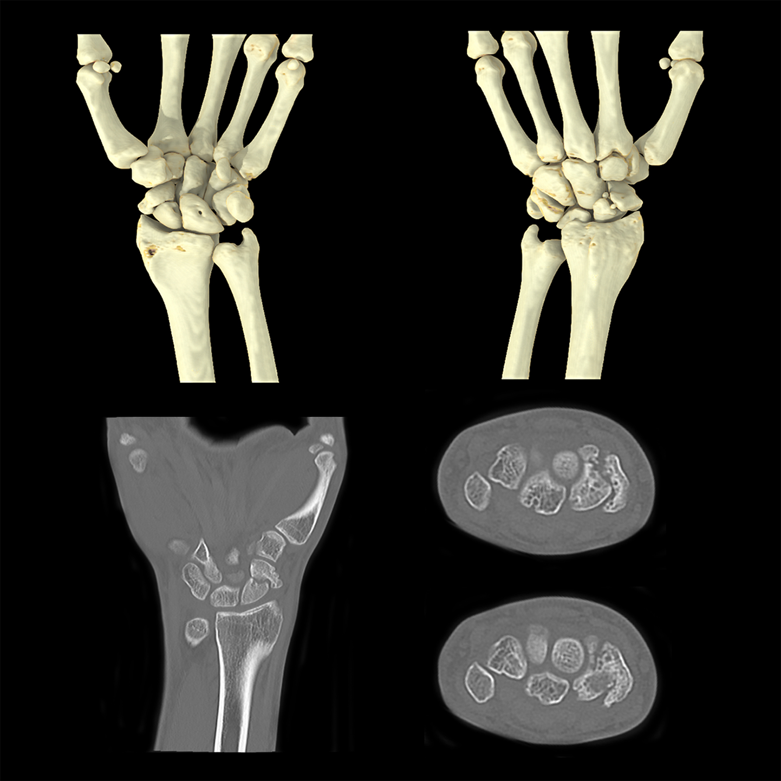 Fractura de escafoide en muñeca, AiCE