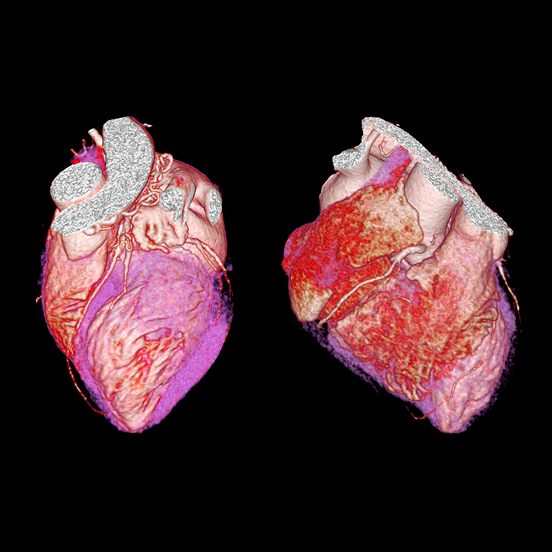 AiCE, Cardiac CTA