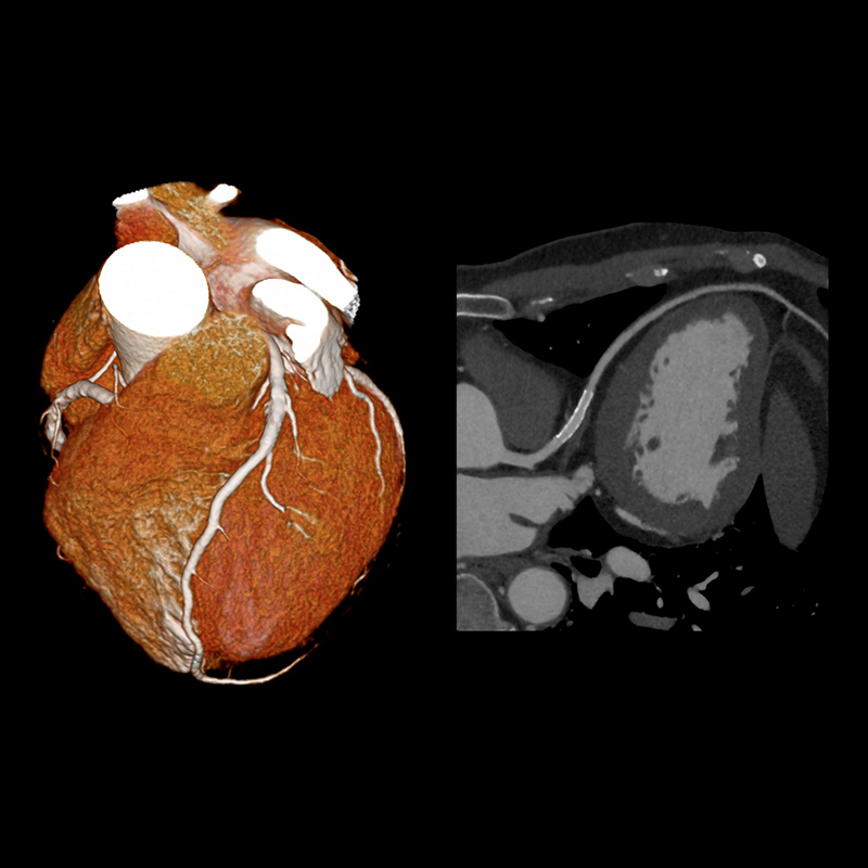 AiCE LAD Stent