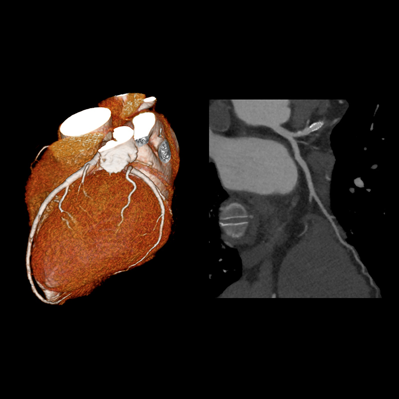 AiCE LAD Stent