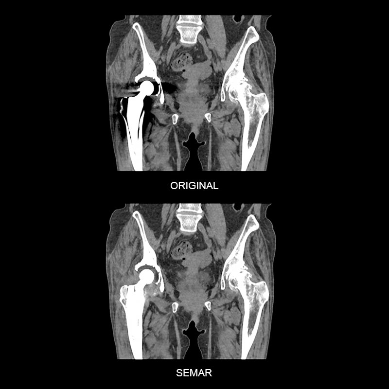 SEMAR, Right Hip Replacement