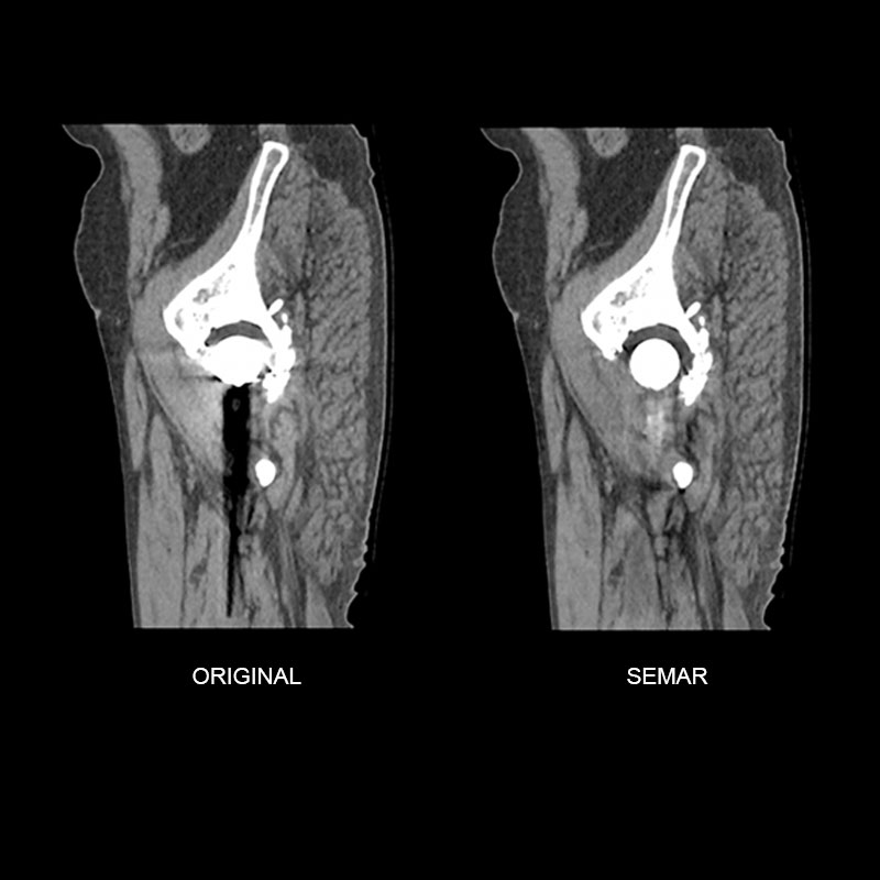 SEMAR, Right Hip Replacement