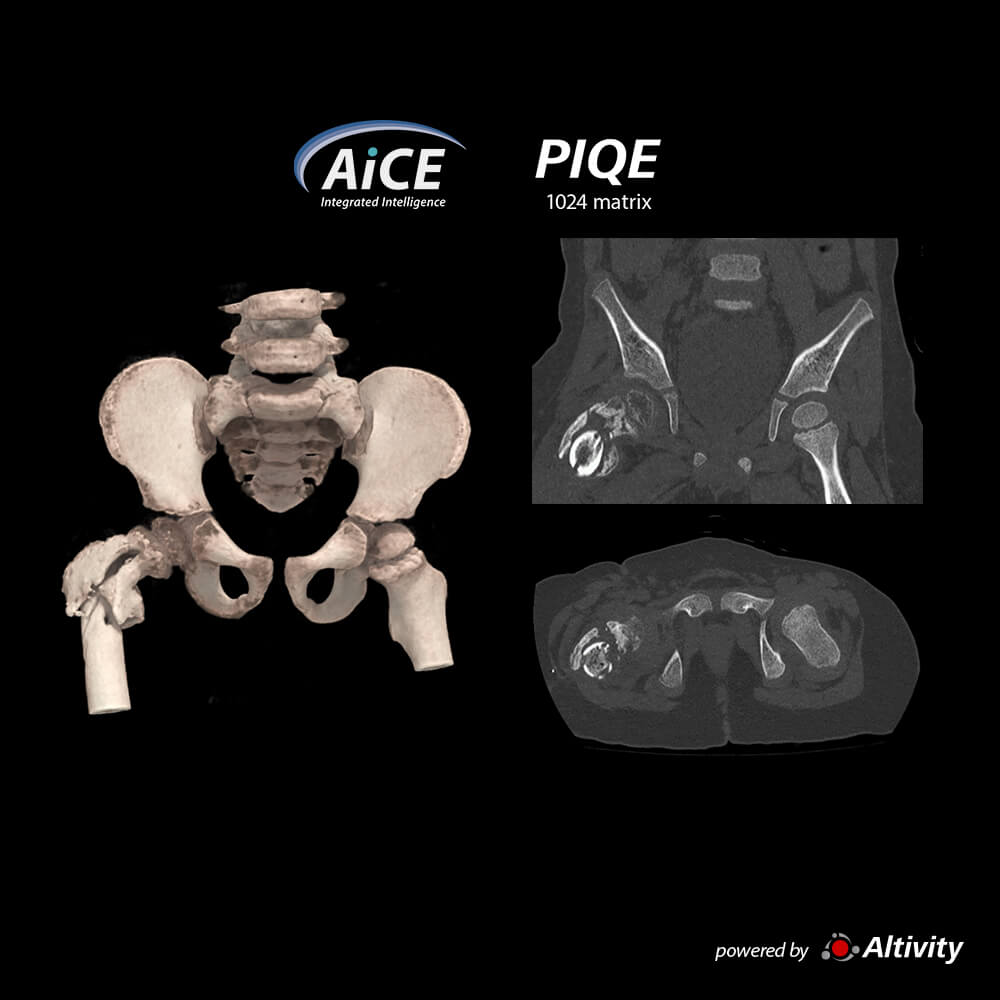 Fractura de pelvis