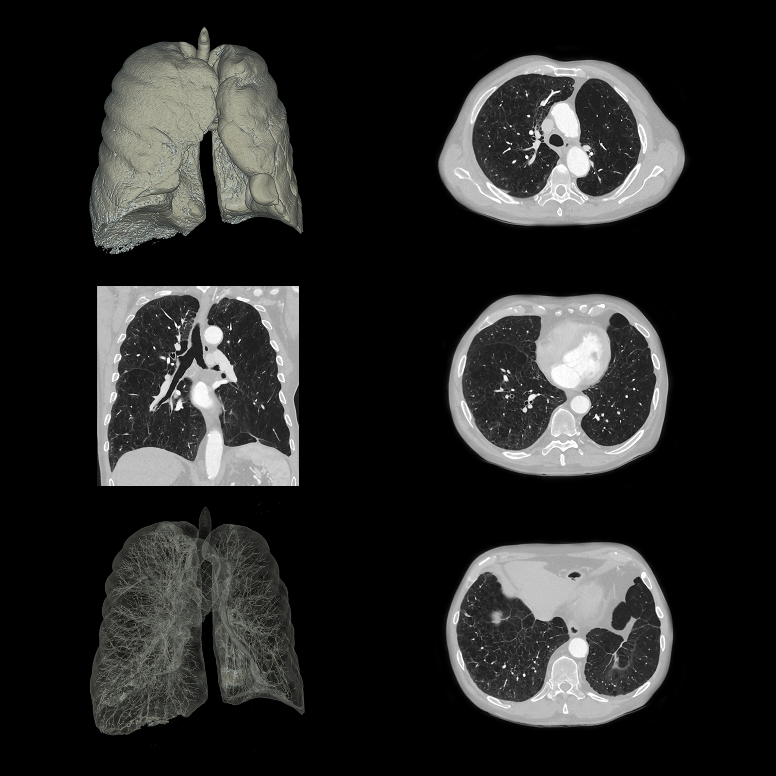 Enfisema pulmonar, AiCE*