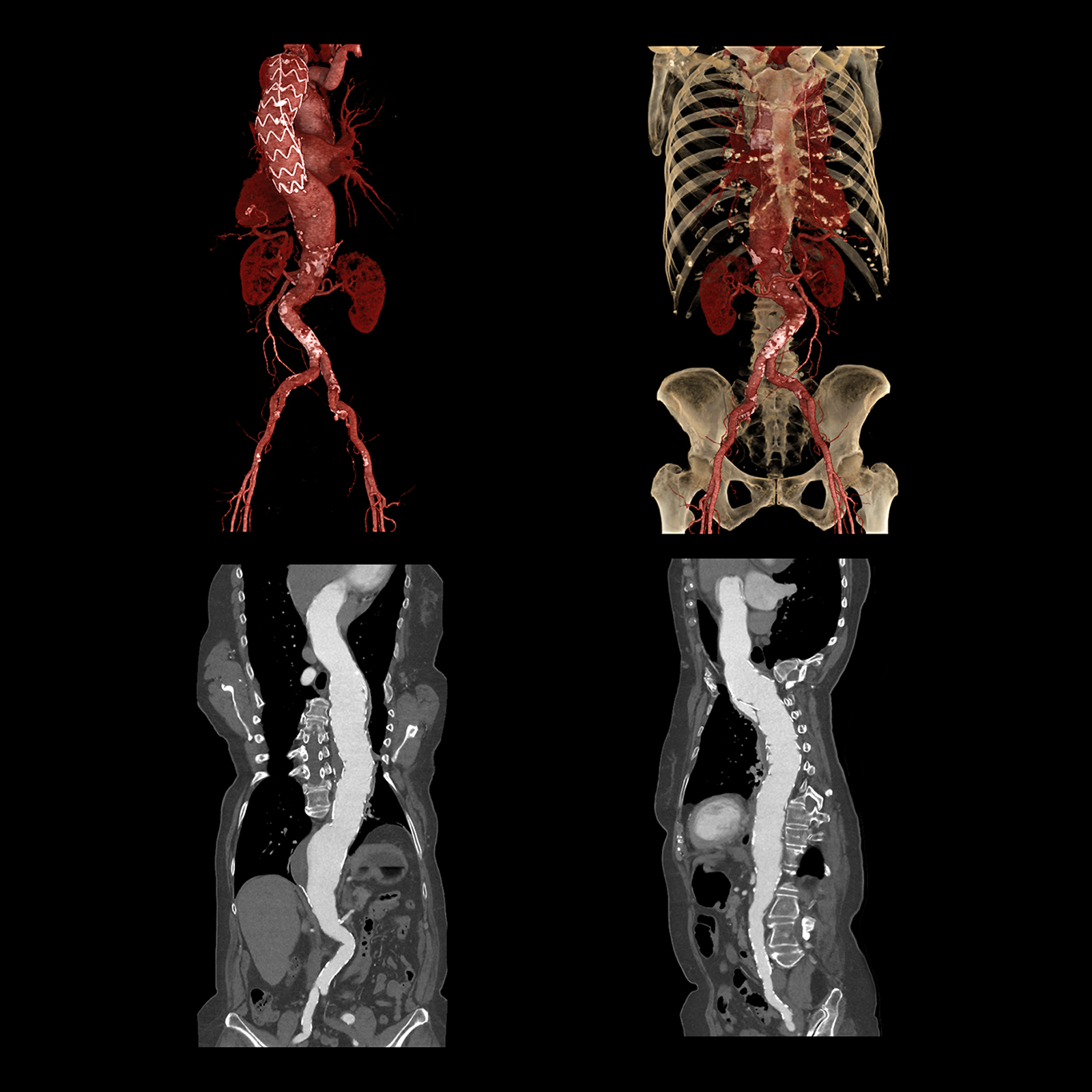 Seguimiento de un Stent en aorta toráxica, AiCE*