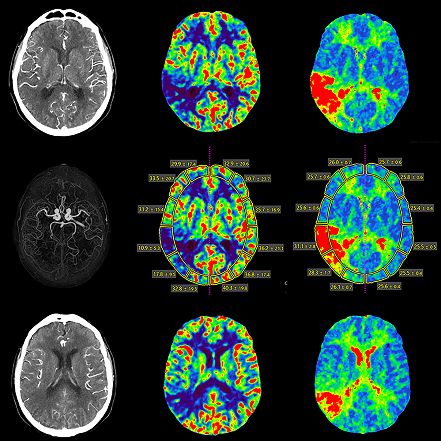 Obstrucción cerebral, lado derecho, Volume, AiCE*