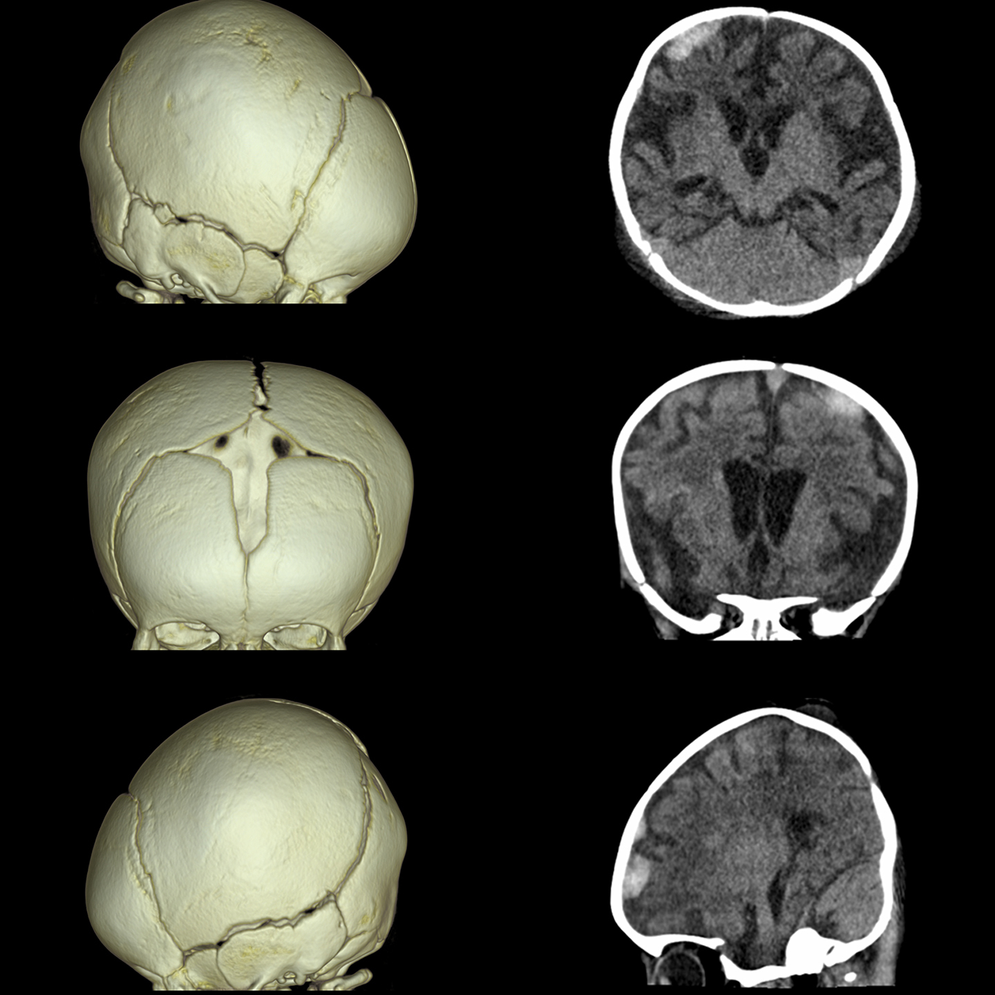 Hematoma cerebrel subdural, Volumen*