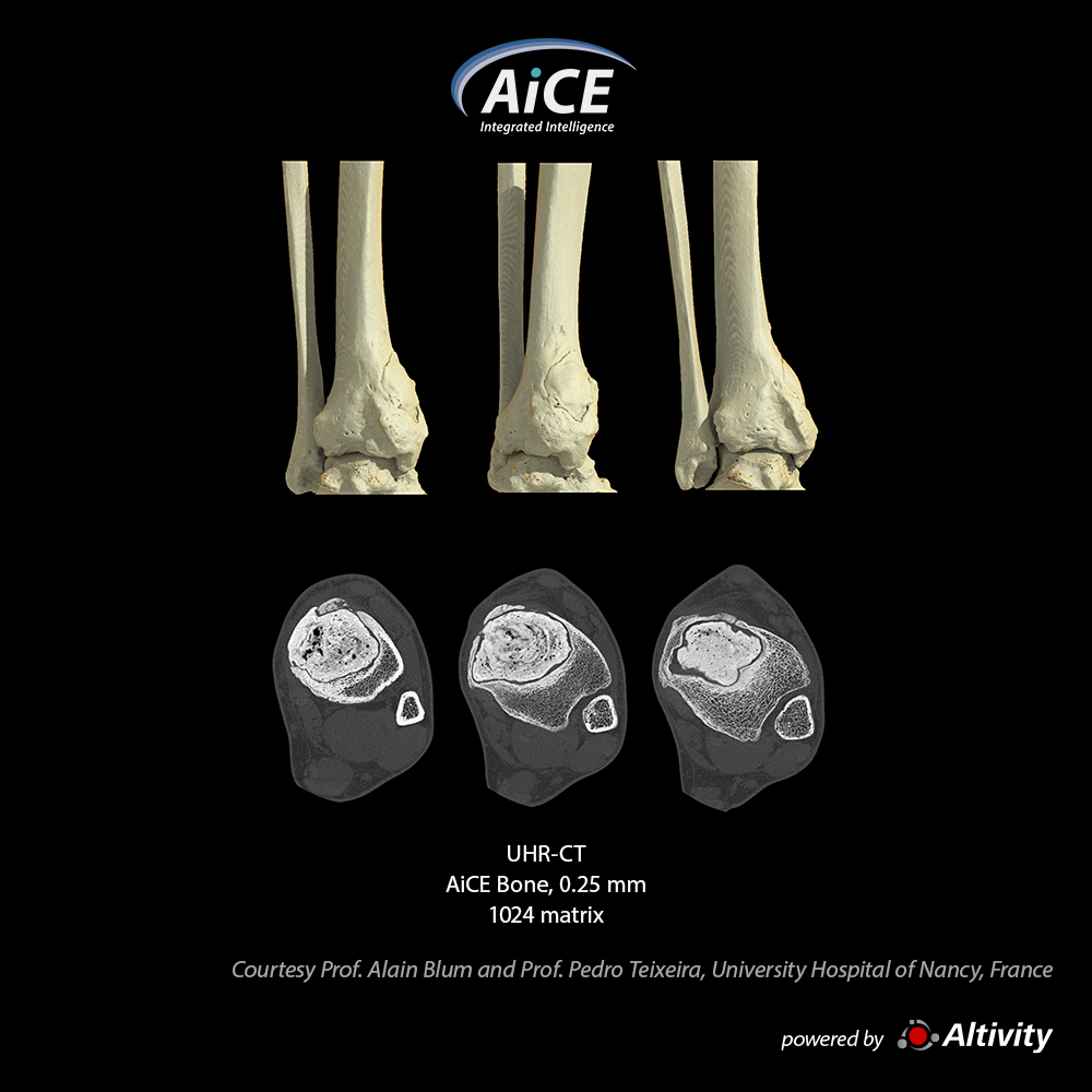 Tumor de tibia