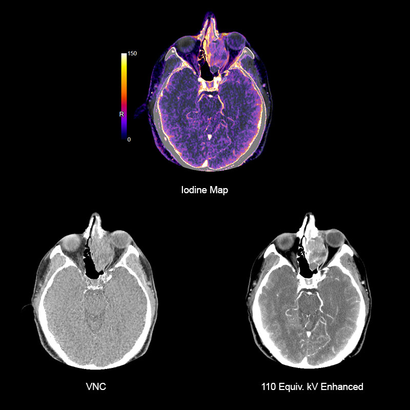 Sinus DE Adenocarcinoma