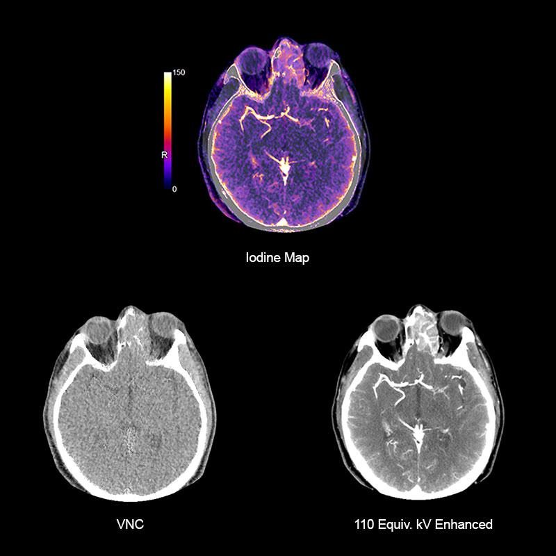 Sinus DE Adenocarcinoma