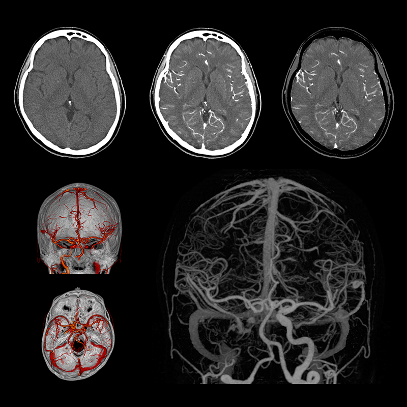 Cerebro CTA SURE Resta Rt. Oclusión ICA
