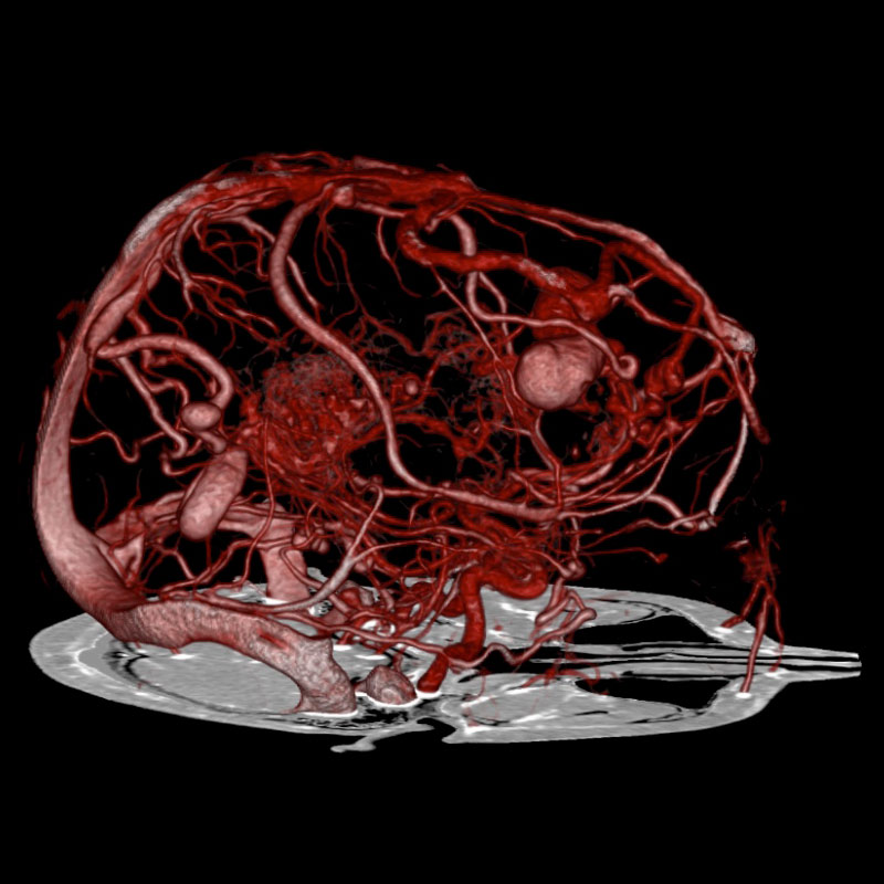 ATC cerebral SURE Aneurismas y MAV de sustracción
