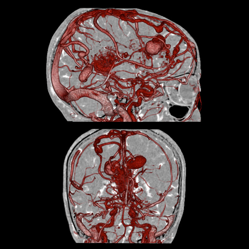 ATC cerebral SURE Aneurismas y MAV de sustracción