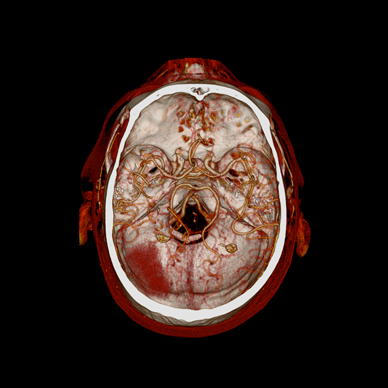 Hemorragia cerebral