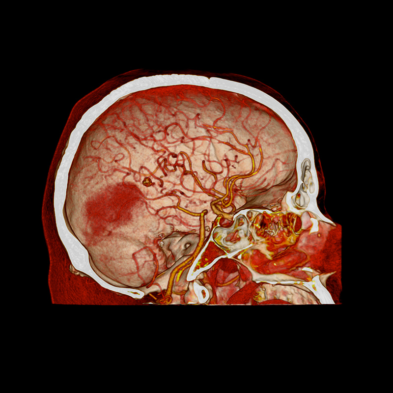 Hemorragia cerebral