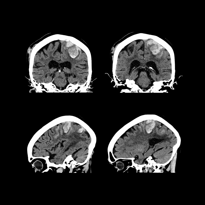 Cerebro, AICE LCD