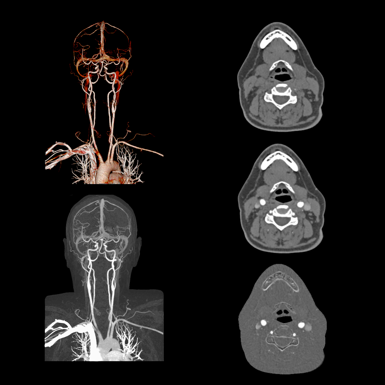 SURE Subtraction, Carotid CTA
