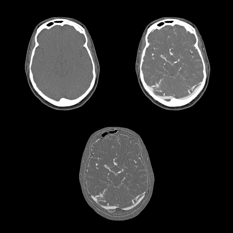 SURE Subtraction, Carotid CTA