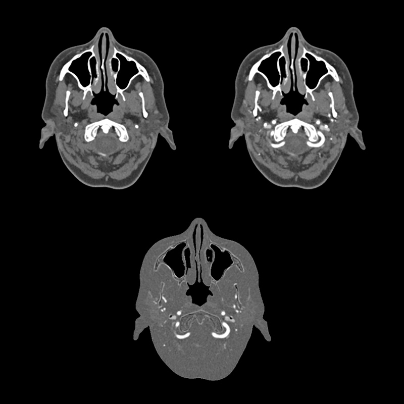 SURE Subtraction, Carotid CTA