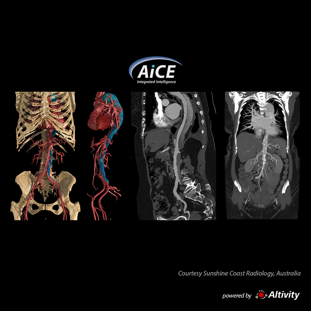 ATC de aorta: disección