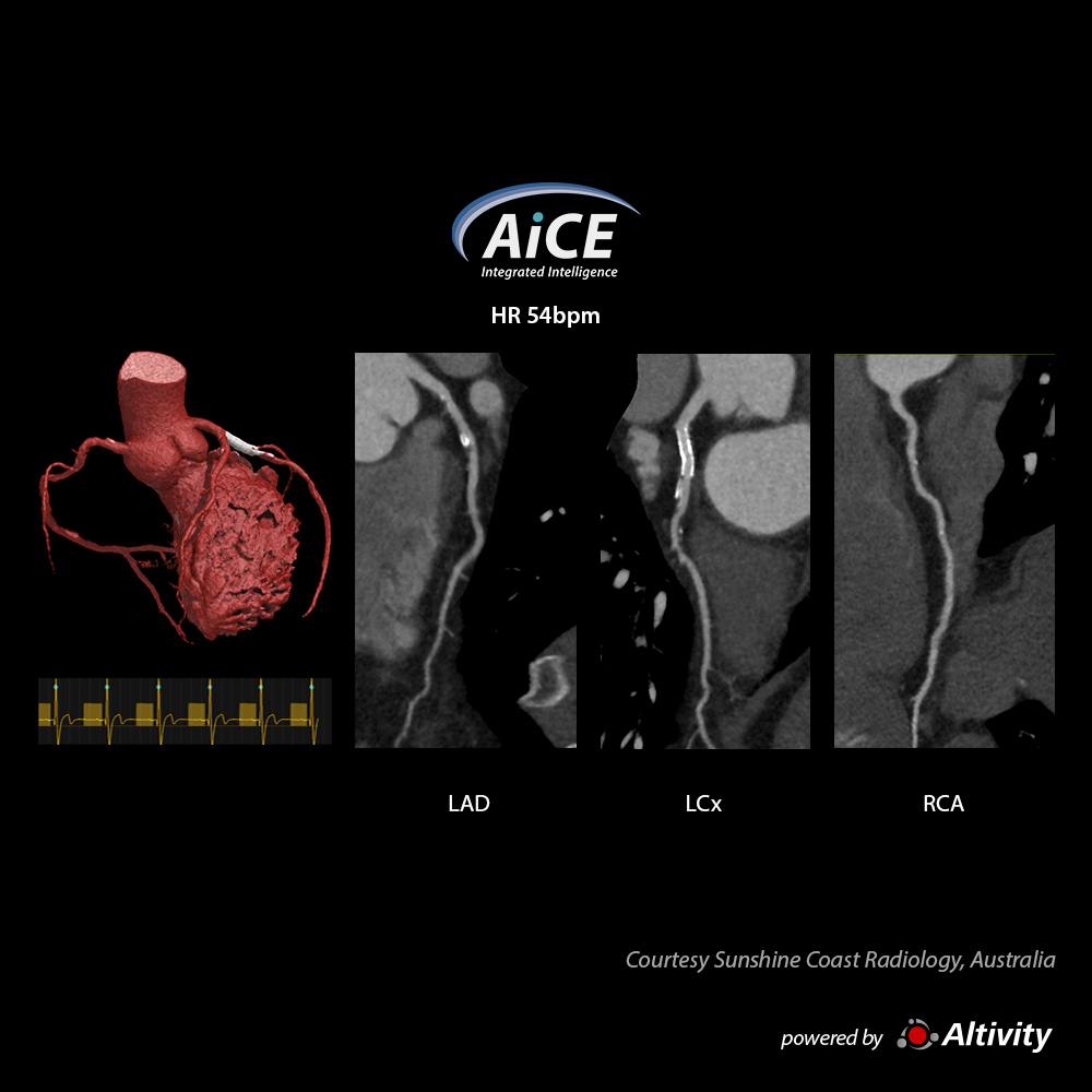 Cardiac - Stent