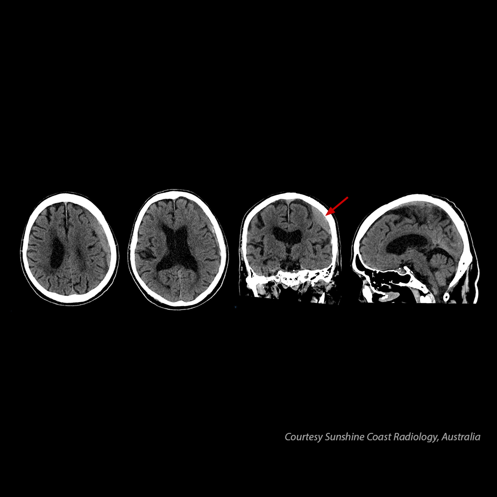 Cerebro – Hematoma subdural