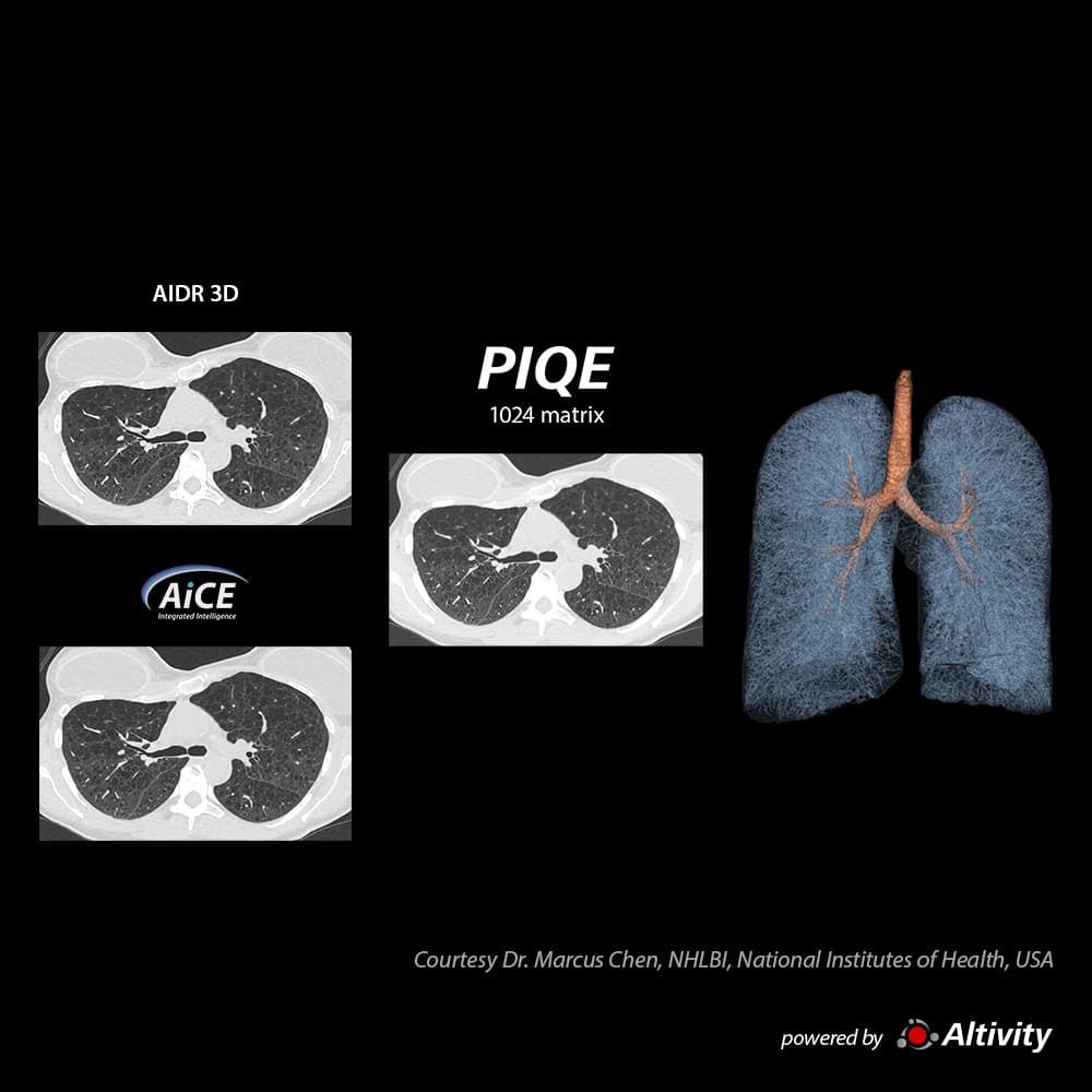 Cystic Lung Disease