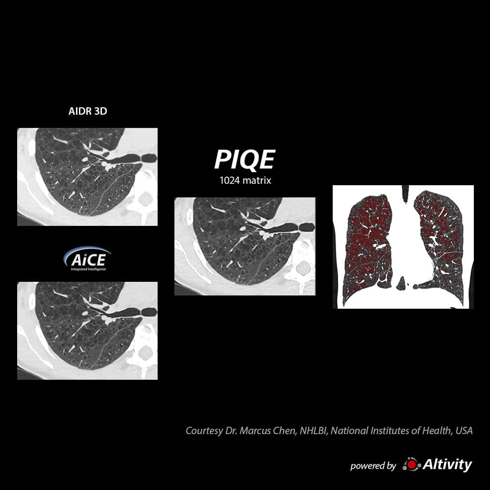 Cystic Lung Disease