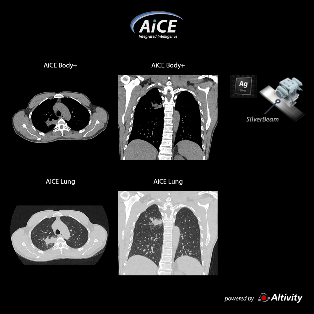 Low dose chest with SilverBeam
