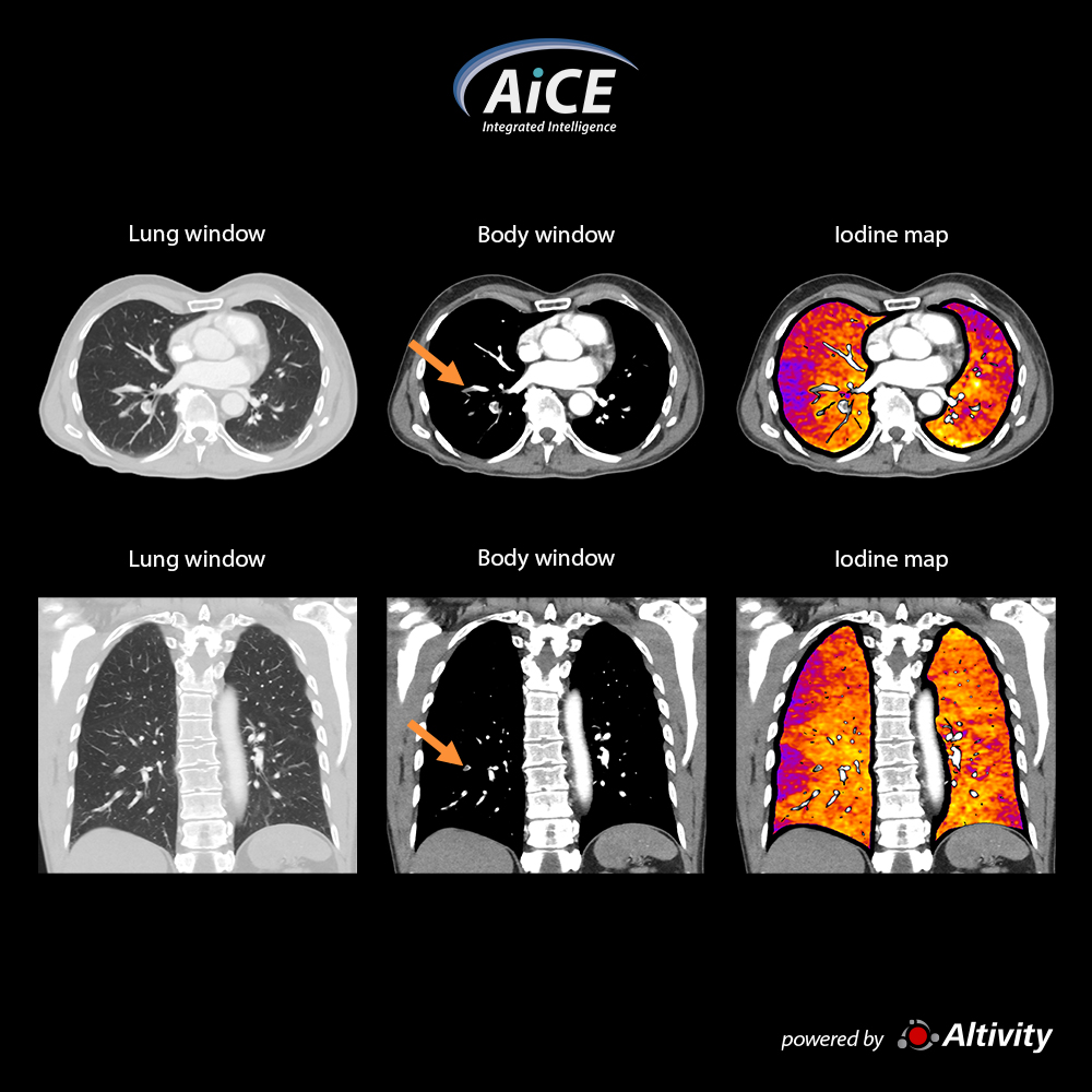 CTA pulmonar - SCT de mapeo de yodo
