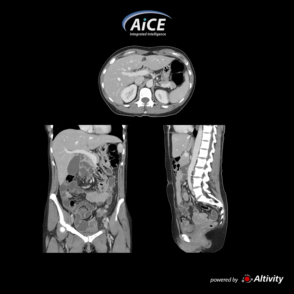Portal Abdomen