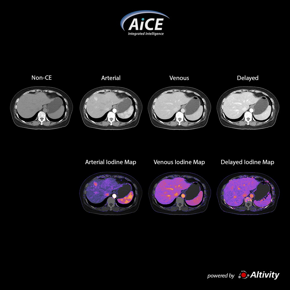 Multi Phase Abdomen – Iodine Mapping SCT