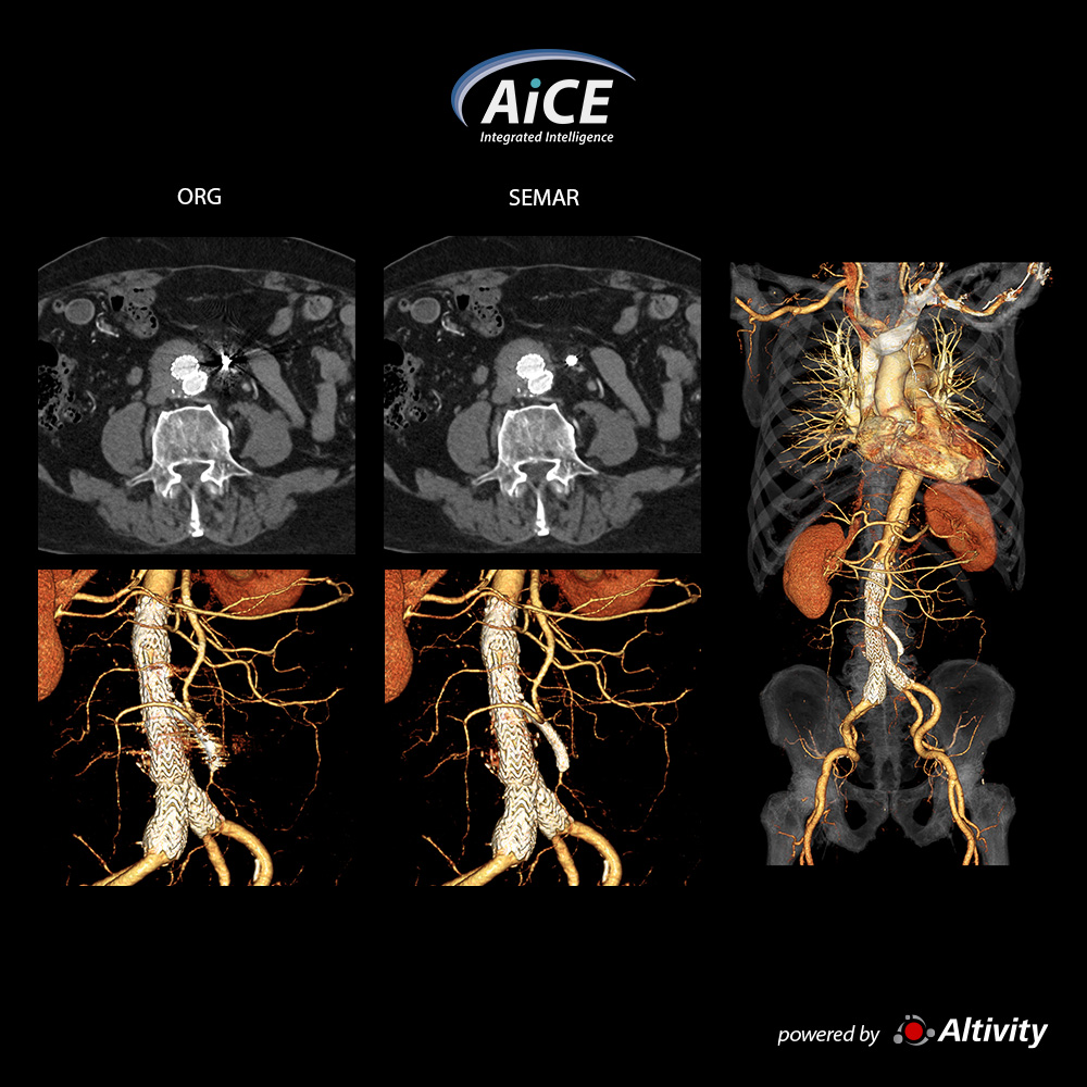 Aorta CTA + SEMAR