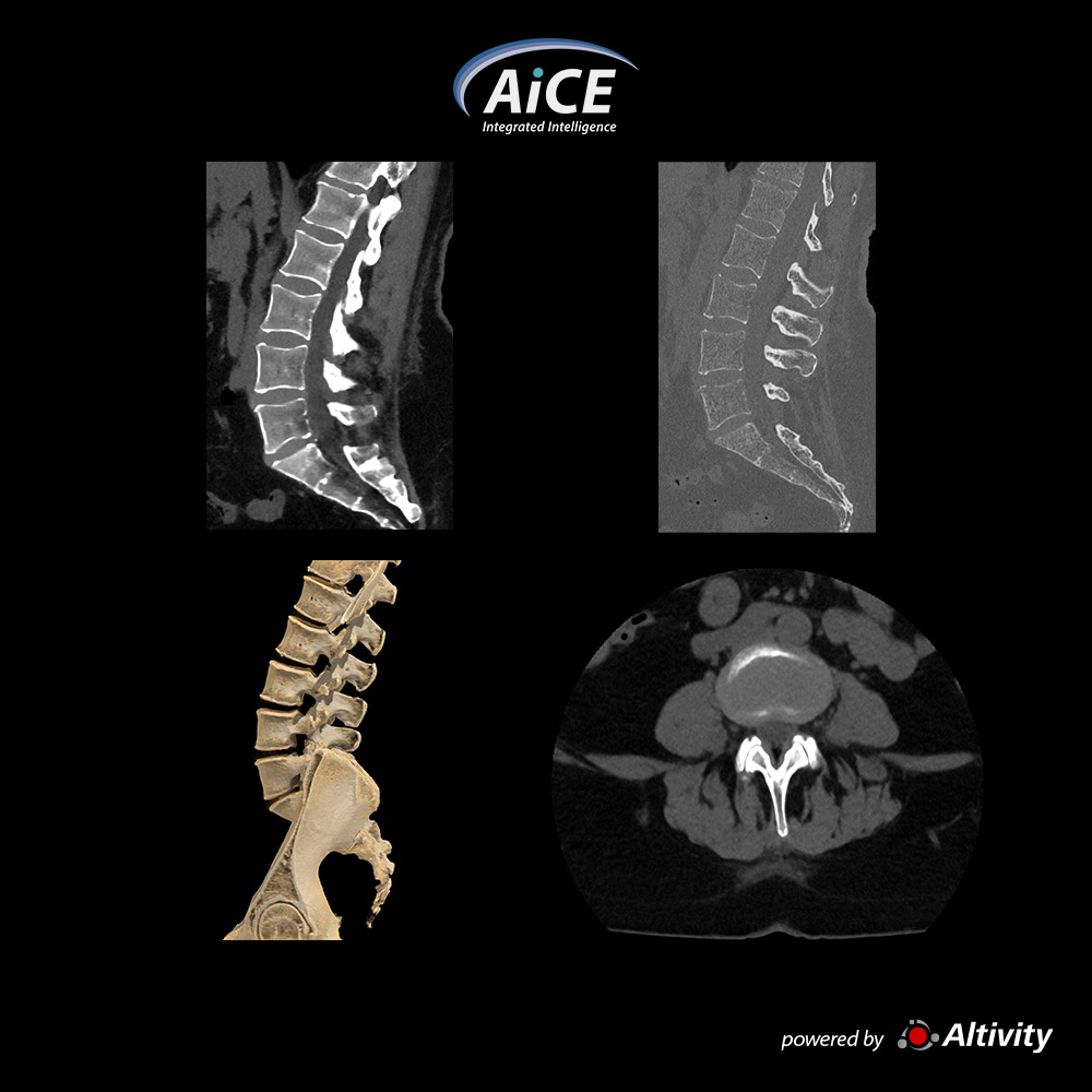 Espina lumbar